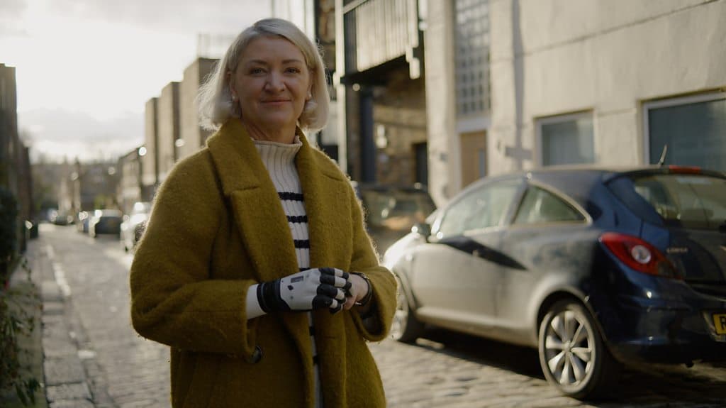 Meet the world's first recipient of an AI-powered bionic arm